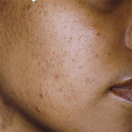 acne in skin of color